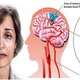 Illustration for article titled Obat Stroke Akibat Darah Tinggiem/em